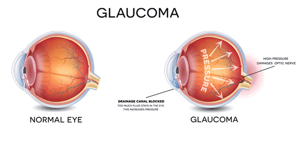 xwhat is glaucoma and how does it affect you png pagespeed ic 2tobe25dqb