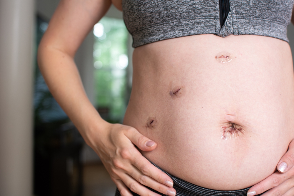 Healing Incisions After Laparoscopic Surgery Recovery